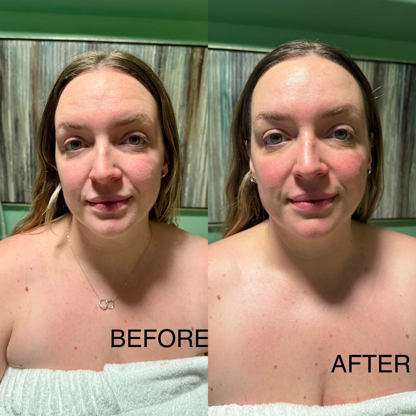 Extensive Buccal Facelift With Lymphatic Drainage & Myofacial Release Treatment 90 Minutes