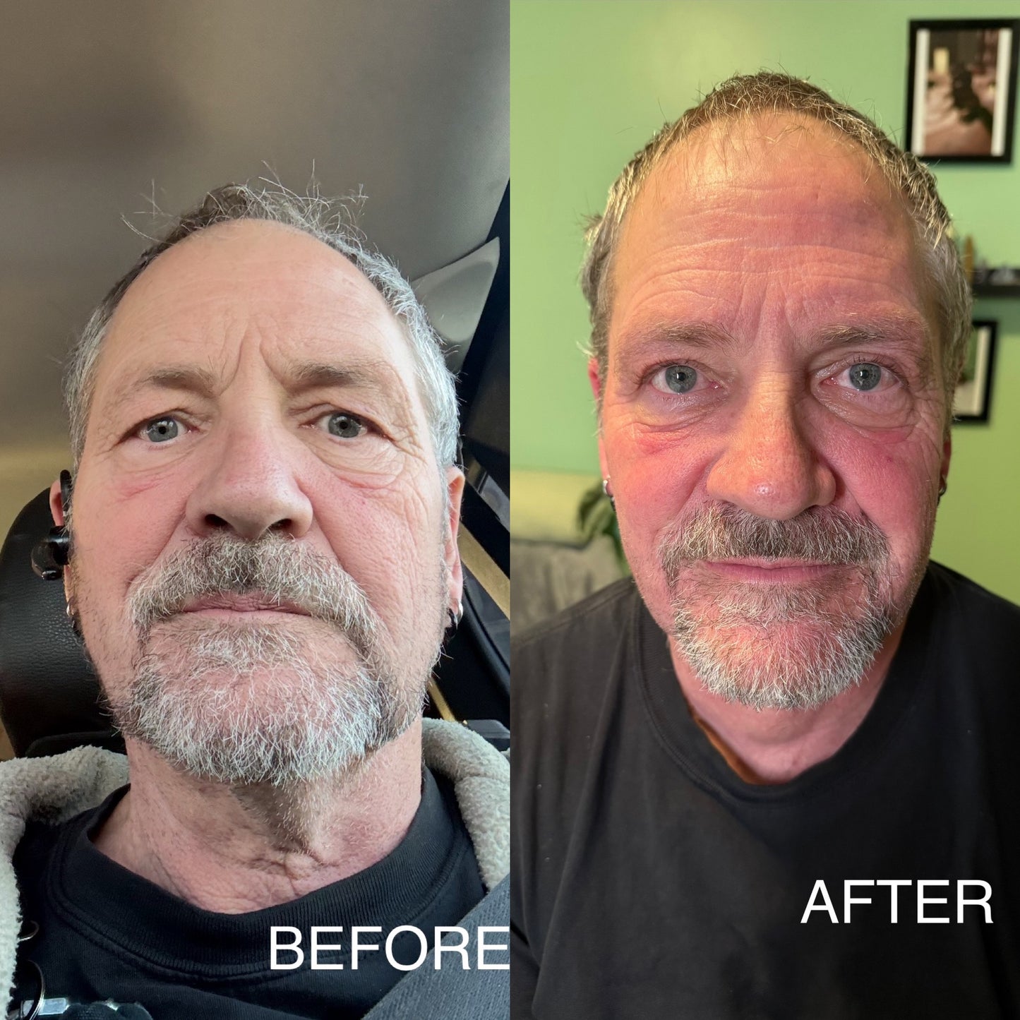 Extensive Buccal Facelift With Lymphatic Drainage & Myofacial Release Treatment 90 Minutes